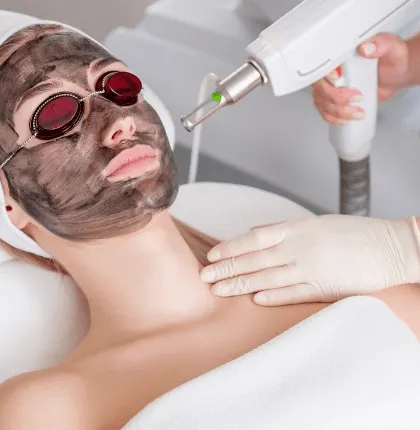 This image captures a Carbon Laser Peel in progress. The laser energy gently heats and vaporizes the carbon particles, taking dead skin cells, excess oil, and impurities with them. The result is instantly smoother, brighter, and refreshed skin.