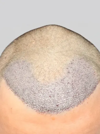 Precision in every graft. A close-up of a 2200 graft placement for a Grade 2 baldness case, focusing on a natural and dense hairline.
