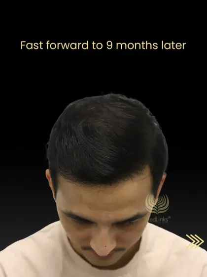 Nine months later, Tika Ram has a full head of hair, showcasing the excellent progress and final result.
