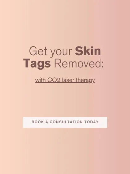If you're ready to get your skin tags removed, CO2 laser therapy is an excellent, safe, and effective option. A consultation is the first step to achieving smoother skin.