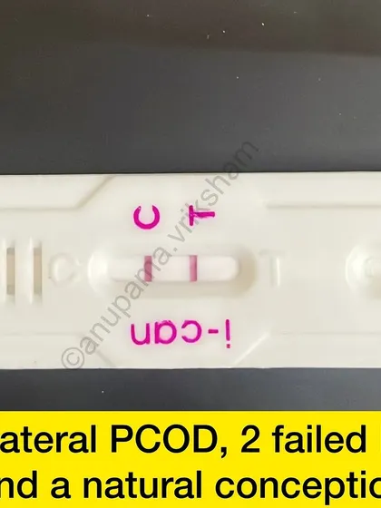 This is a wonderful result for a student with bilateral PCOD and 2 failed IUIs. She followed the diet and exercise guidance strictly and conceived naturally.