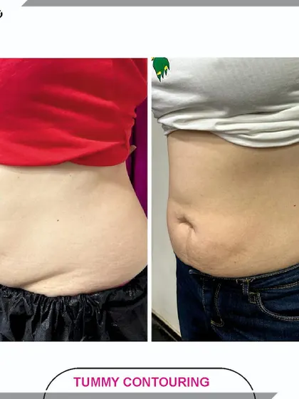 This is the result of our Tummy Contouring program after just one session of Cristal Pro. We focus on reducing stubborn belly fat and tightening the skin, helping our clients feel more confident and comfortable.
