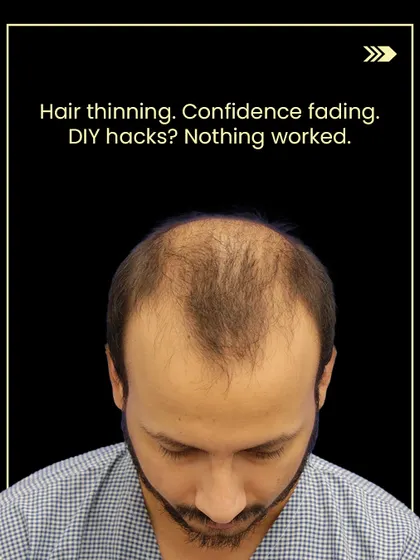 Dhruv came to us after trying various DIY hacks for his thinning hair that didn't work. This was his hair condition before starting treatment.