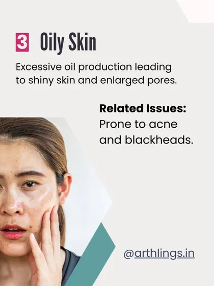 Oily skin is caused by excessive oil production, which leads to a shiny appearance and enlarged pores. It is often more prone to acne and blackheads.