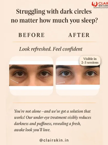 Tired of looking tired? Our under-eye treatment visibly reduces darkness and puffiness. This before and after shows a refreshed, more awake appearance after just a few sessions.
