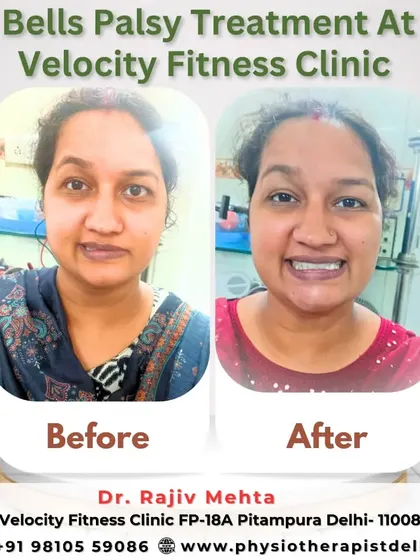 This is one of the most rewarding parts of my work. This patient came to me for Bell's Palsy treatment, and this before and after image shows the incredible progress we made together, restoring her smile and facial control.
