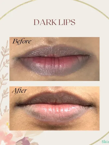 Dark lips can be a concern for many, and this before-and-after image shows the results possible with our Qs Nd:YAG laser. In just two sessions, we were able to visibly lighten the lip hyperpigmentation for this patient.