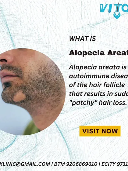 This graphic explains Alopecia Areata, an autoimmune disease that causes sudden, patchy hair loss on the scalp, beard, or body. We provide specialized treatments to manage this condition and promote hair regrowth in the affected areas.