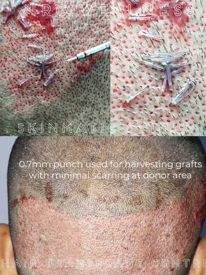 Our technique is built on precision. We use a 0.7mm punch to harvest hair grafts, which is a key reason our FUE procedure results in minimal scarring and faster healing for the donor area on the scalp.