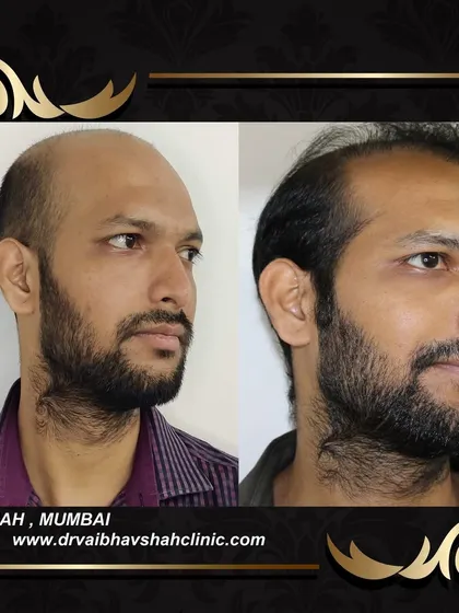 A side view showing the newly established hairline and how it blends into the rest of his hair.