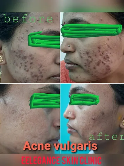 This is a powerful example of how we can manage post-adolescent acne, or acne vulgaris. This patient's journey involved a customized treatment plan that significantly cleared up active acne and reduced inflammation and scarring. Seeing my patients regain their confidence is the best part of my work.