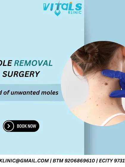 An informational graphic explaining mole removal surgery. I offer this procedure to address unwanted moles, using either laser or surgical excision methods depending on the mole's characteristics.
