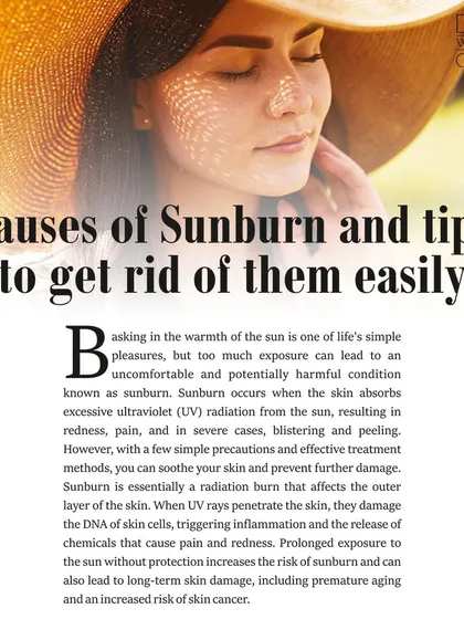 My article on the causes of sunburn and tips to treat it, covering everything from hydration to the right skincare products.