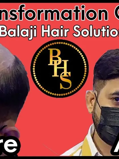 This client's transformation in our Gurgaon studio is a testament to our work. We address advanced hair loss with a high-quality hair system and expert styling.