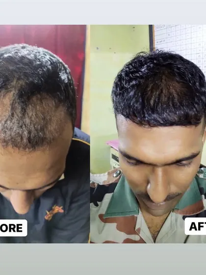 We are proud to serve clients from all walks of life. This shows the 5-month progress for a member of the armed forces, demonstrating significant new growth and coverage after his FUE procedure.