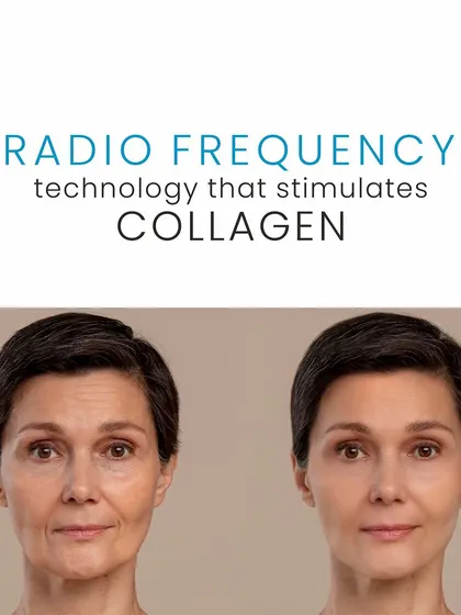 This before-and-after image demonstrates the power of Thermage. The treatment uses radiofrequency technology to kickstart your body's collagen production, resulting in a naturally lifted and more youthful appearance over time.