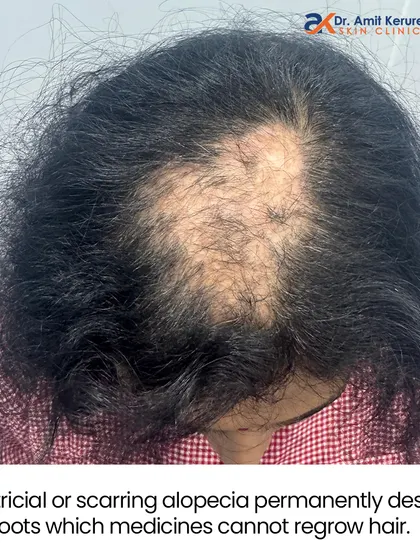 This image explains what cicatricial or scarring alopecia is. This condition permanently destroys hair roots, which means medicines alone cannot regrow the hair. This is why a proper diagnosis is critical to set the right treatment path.