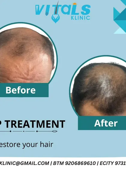 This before and after image showcases the results of PRP treatment for a patient with significant hair thinning on the crown. The 'after' photo shows a noticeable increase in hair coverage and density, demonstrating the restorative power of this regenerative therapy.