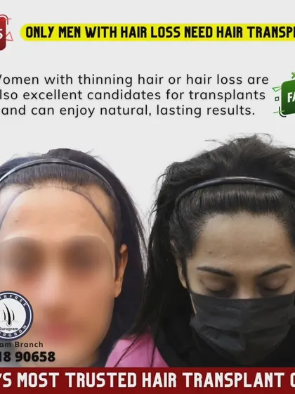 Hair transplants are not just for complete baldness. This patient had significant thinning, and we were able to restore her hairline and confidence. This shows a before and after of a female hair transplant.