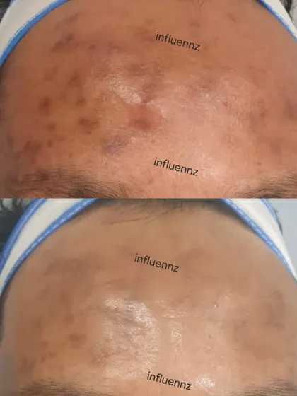 This before-and-after focuses on the forehead, showing a marked reduction in acne excoriée and associated pigmentation, resulting in a smoother and more even skin surface.