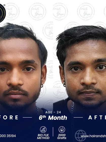 The frontal view at 6 months. This targeted BIO FUE procedure has successfully addressed the receding hairline.