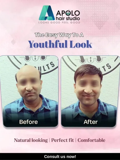 Our hair patches for men are designed for a perfect, comfortable fit. This client's transformation resulted in a natural and youthful look that he can wear with confidence every day.