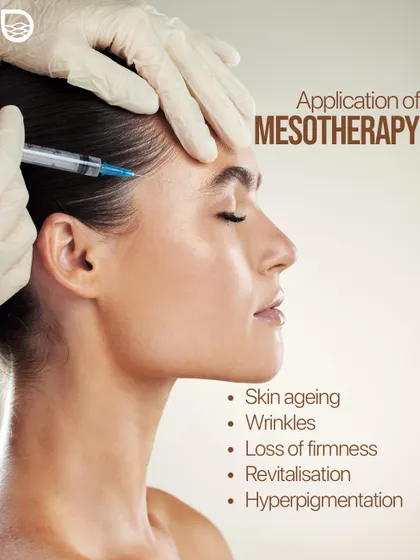 Mesotherapy is a versatile treatment for skin aging, wrinkles, loss of firmness, and hyperpigmentation. Here, the solution is being applied to revitalize the skin.