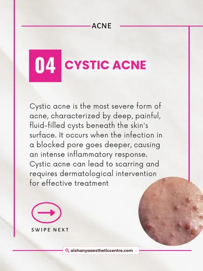 Cystic acne is the most severe form, characterized by deep, painful, fluid-filled cysts. This type of acne has a high risk of scarring and should always be treated by a medical professional.