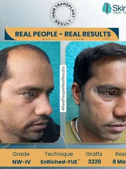 A side view of the 33-year-old patient's 8-month result. This angle demonstrates the natural flow and density of the transplanted hair, seamlessly blending with his existing hair.