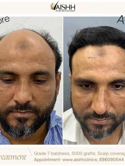 I believe no case is too advanced. This patient came to me with Grade 7 baldness, and using the FUE-DHT technique, we achieved this full-coverage result in just six months. It shows what's possible with the right plan and technology.