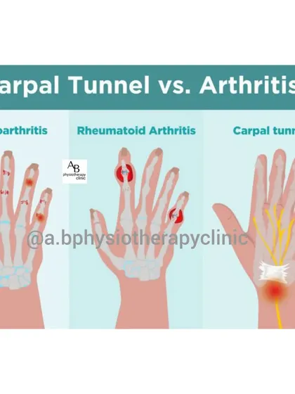Is it carpal tunnel or arthritis? This visual guide helps differentiate between osteoarthritis, rheumatoid arthritis, and carpal tunnel syndrome by showing how each condition typically affects the joints and nerves in the hand and wrist.