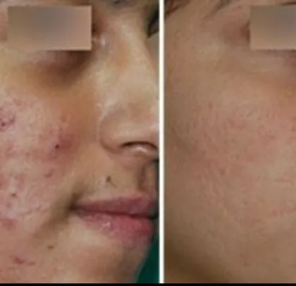 Here, we addressed both active acne and early scarring simultaneously. The treatment plan included medical management to control breakouts, followed by gentle laser therapy to reduce redness and improve the texture left behind.