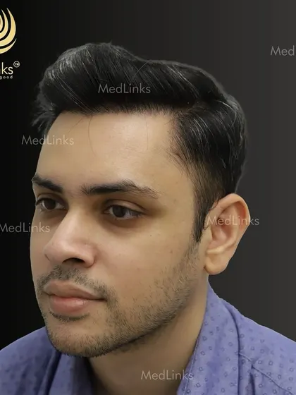 The final result from the side, showing a natural and dense hairline.