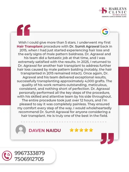 This review from a patient I treated in 2015 and again in 2025 highlights my commitment to long-term results and patient care. He notes that the hair from his first transplant remained intact a decade later, a testament to the permanence of the FUE technique when done correctly.