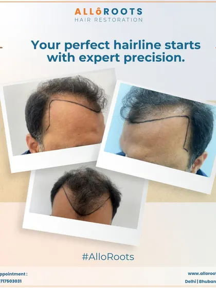 A natural hairline is not a straight line. This image shows examples of hairlines I have designed, featuring the soft, irregular patterns that are essential for a result that looks completely real.