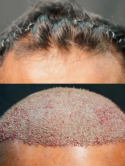 This image shows the immediate result of a 4600-graft FUE procedure. The 'before' shows a receded hairline, and the 'after' displays the newly created hairline with densely packed grafts on day zero.