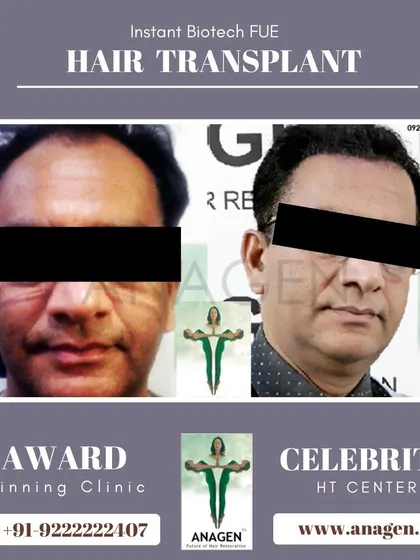 Another example of a successful Instant Biotech FUE hair transplant. The patient's face is obscured, but the hair transformation is clear and impressive.