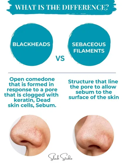 Do you know the difference between blackheads and sebaceous filaments? This graphic breaks it down so you can better understand and treat your skin.