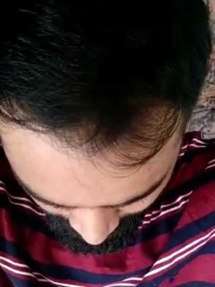 This image shows a typical case of male pattern baldness with thinning at the crown and a receding hairline. This is the kind of hair loss that I effectively treat using GFC and PRP therapies to restore density.