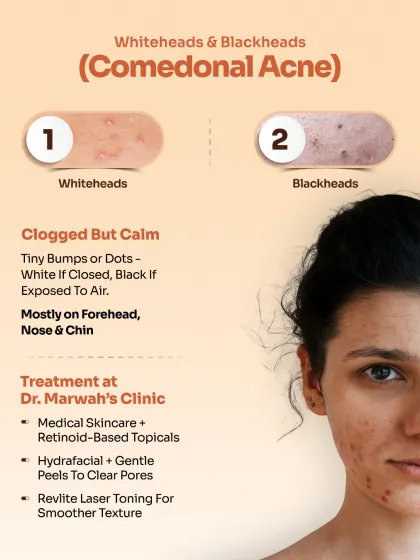 This graphic explains Comedonal Acne, which includes whiteheads and blackheads. These are caused by clogged pores and are typically treated with medical skincare, retinoids, HydraFacials, and gentle peels to clear congestion and smooth texture.