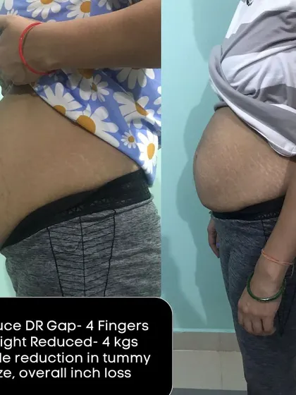 This client achieved a 4-finger DR gap reduction and 4 kg weight loss, resulting in a visible reduction in tummy size and overall inch loss.