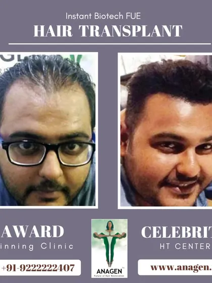 An astonishing result using our Instant Biotech FUE technique. This patient's transformation from significant hair loss to a full head of hair is a testament to our expertise.