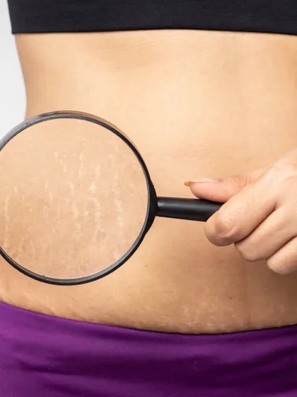 Stretch marks are a common concern that I treat with methods designed to improve skin quality and elasticity. This image highlights the issue, for which I offer solutions like microneedling and fractional lasers.