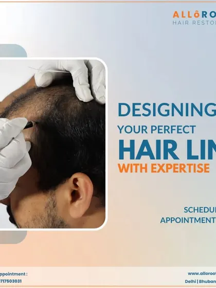 Designing your perfect hairline is an art. This image shows me marking the hairline with expertise and precision, ensuring the final result will be both natural and aesthetically pleasing.