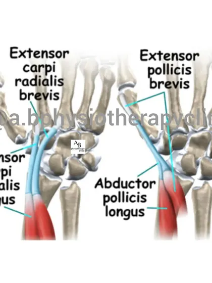 This anatomical illustration provides a detailed view of the wrist extensor tendons involved in Intersection Syndrome. Understanding which specific tendons are affected allows us to create a highly targeted treatment plan for our patients.