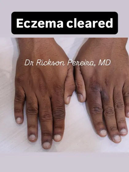 This is the result after two months of our targeted laser and topical therapy. The skin is completely healed, and the patient is free from the itching and embarrassment the condition caused for years.