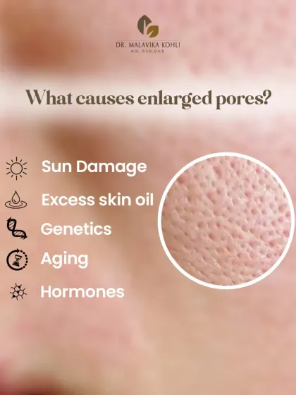 What causes enlarged pores? This infographic explains the common culprits, including sun damage, excess skin oil, genetics, ageing, and hormones. Understanding the cause is the first step to finding a solution.