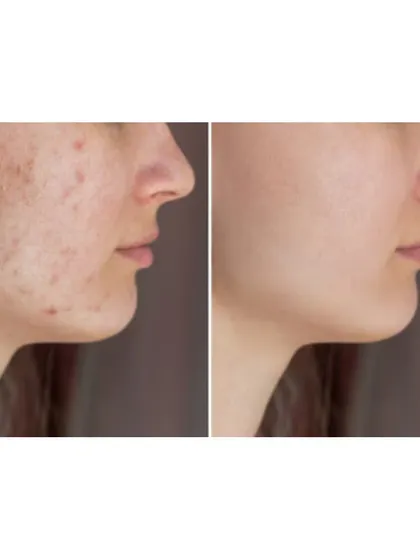 A classic before-and-after of acne scar treatment. My goal is to create a customized plan that might include lasers, microneedling, or peels to achieve the smoothest possible texture and restore your confidence.