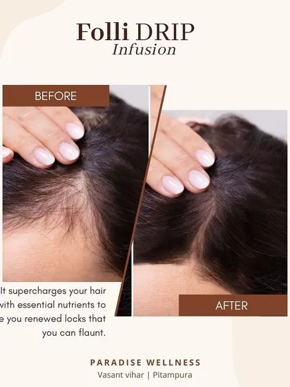 This before-and-after image shows the results of our Folli Drip Infusion for hair. The treatment works by delivering essential nutrients directly to the hair follicles, which helps to control hair fall and promote the growth of healthier, stronger hair.