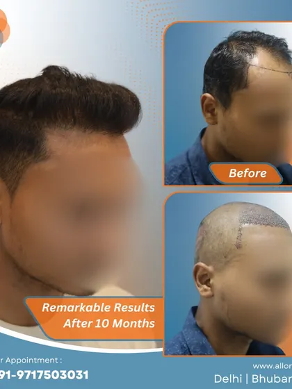 These images show the remarkable results after 10 months, including the planning stage. It's a clear demonstration of how careful planning leads to a successful and natural-looking outcome.
